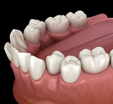 Illustration of crooked teeth
