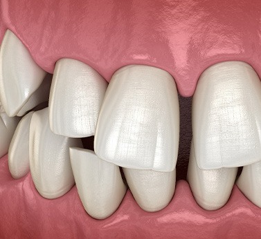 Illustration of gapped teeth
