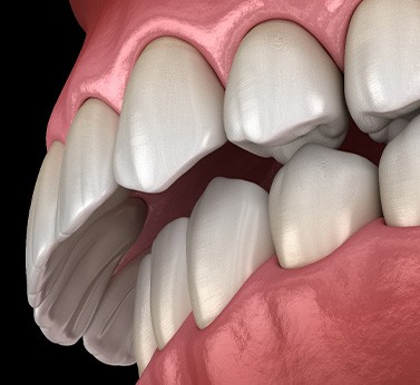 Illustration of an overbite