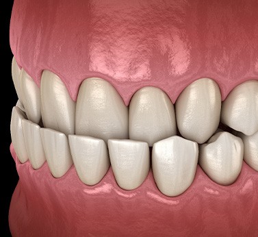 Illustration of an underbite