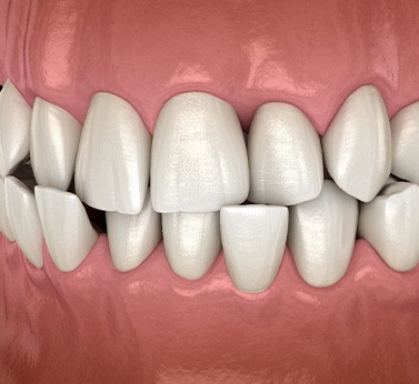 Illustration of a crossbite