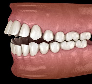 Illustration of an open bite